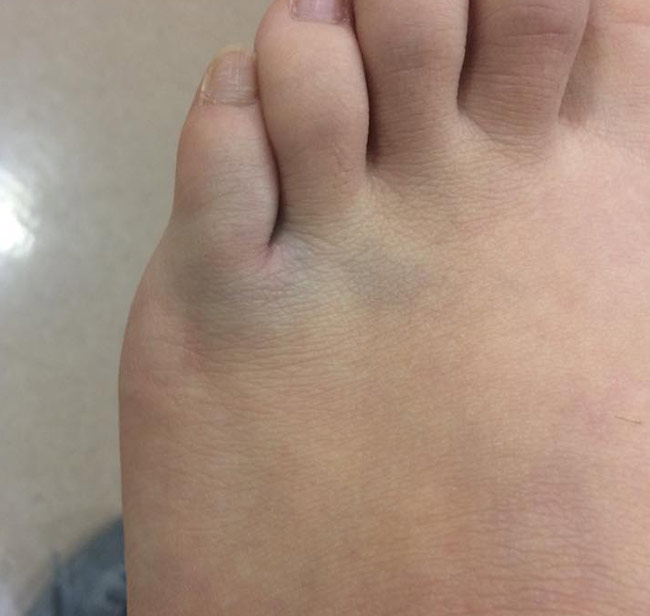 足の指 骨折